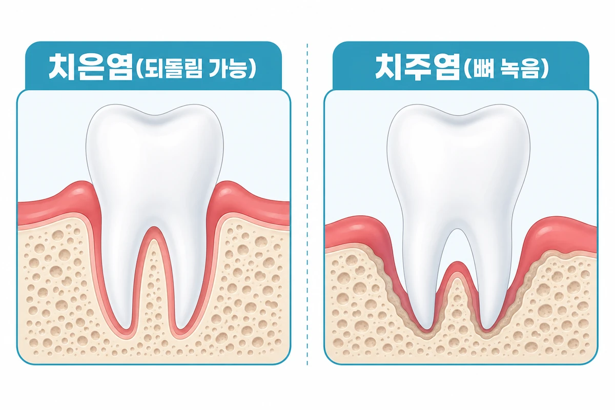 치은염과 치주염 비교