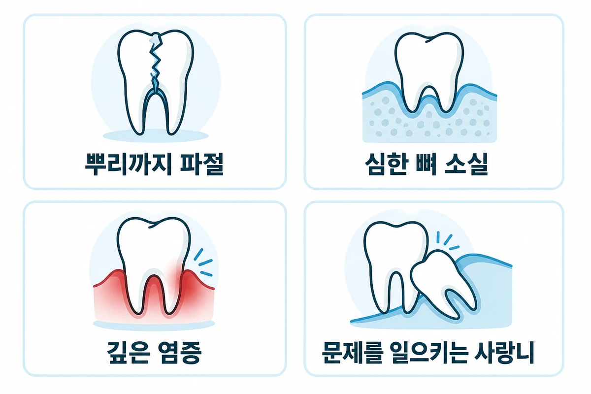 발치를 고려하는 네 가지 기준 인포그래픽