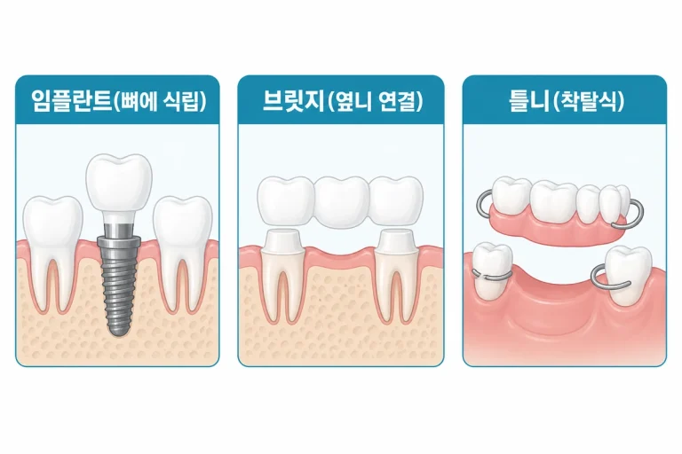 임플란트 브릿지 틀니 세 가지 방법 비교