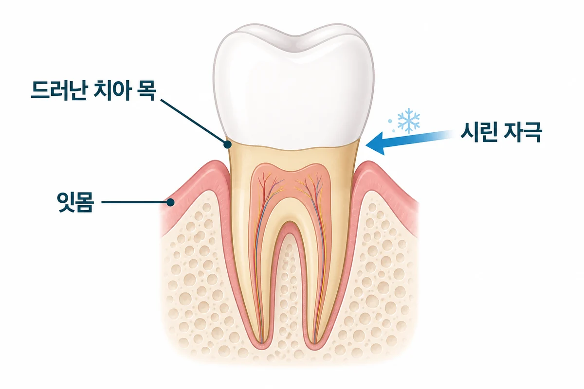 잇몸이 내려가 드러난 치아 목과 시린 자극을 표시한 단면도