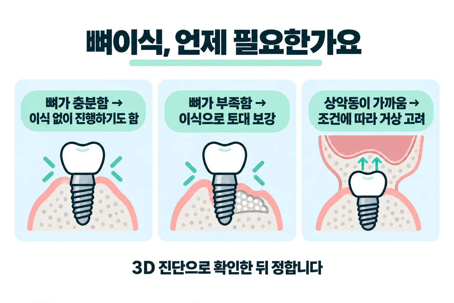 임플란트 뼈이식이 필요한 경우와 필요 없는 경우를 뼈 상태로 나눈 안내도