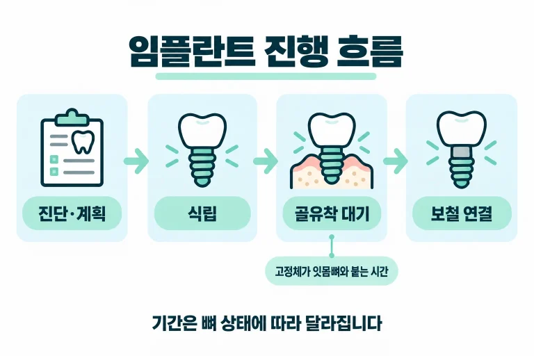 임플란트 진행 흐름을 단계로 정리한 안내도