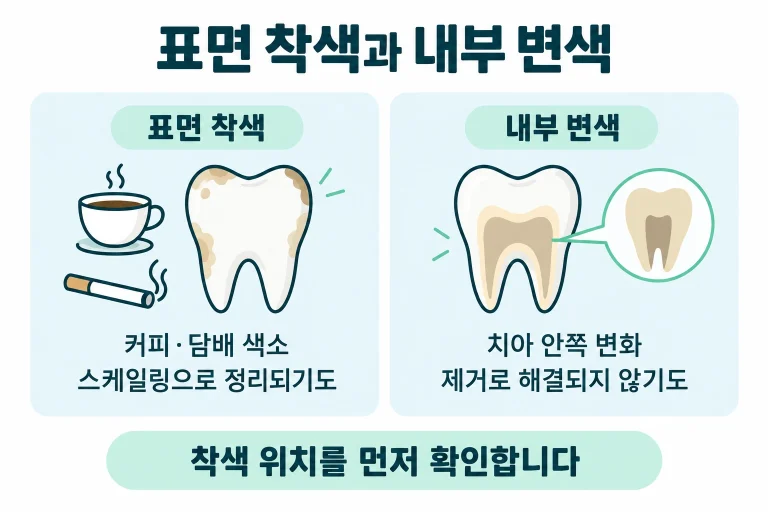 동탄에서 커피·담배 착색이 스케일링으로 지워지는지 궁금하다면, 착색과 치석의 차이와 EMS 에어플로우로 표면 착색을 제거하는 방식을 정리했습니다